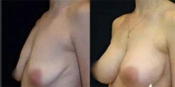 femiform
